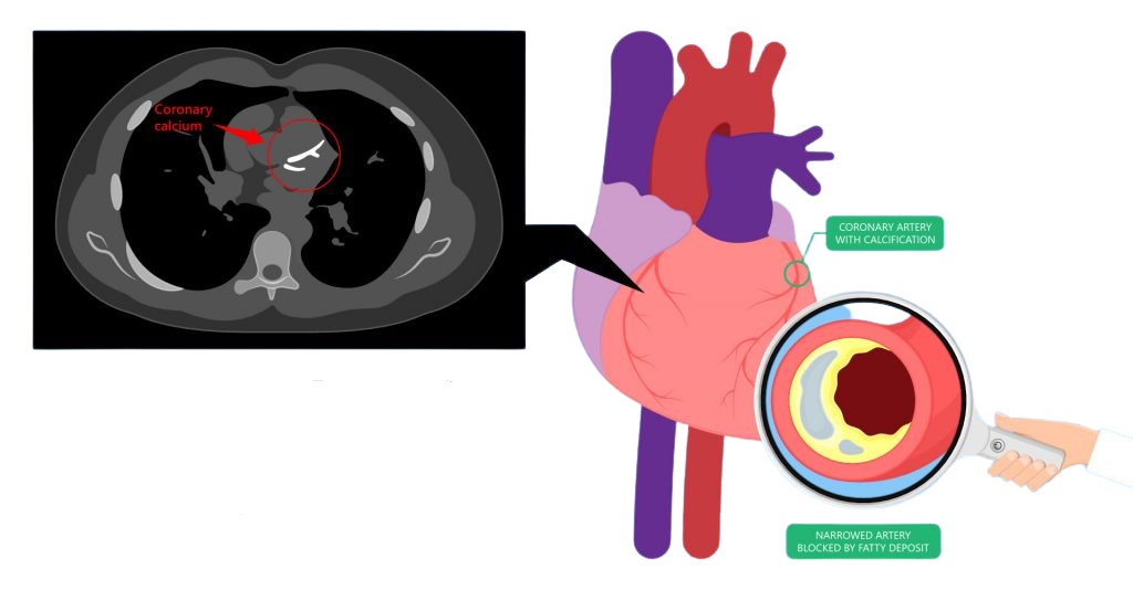 CT Coronary Angiography and CT Calcium Scoring Universal Hospital
