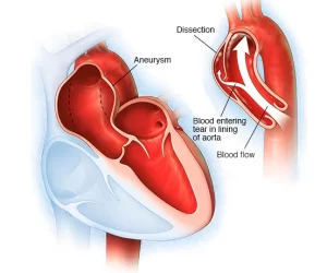 Aortic Aneurysms and Dissections