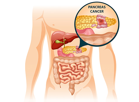 Pancreatic Cancer